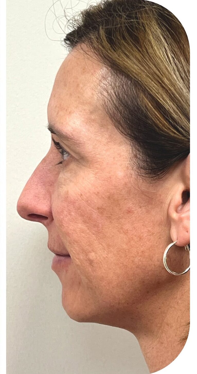 After Image: Biostimulator - left-side