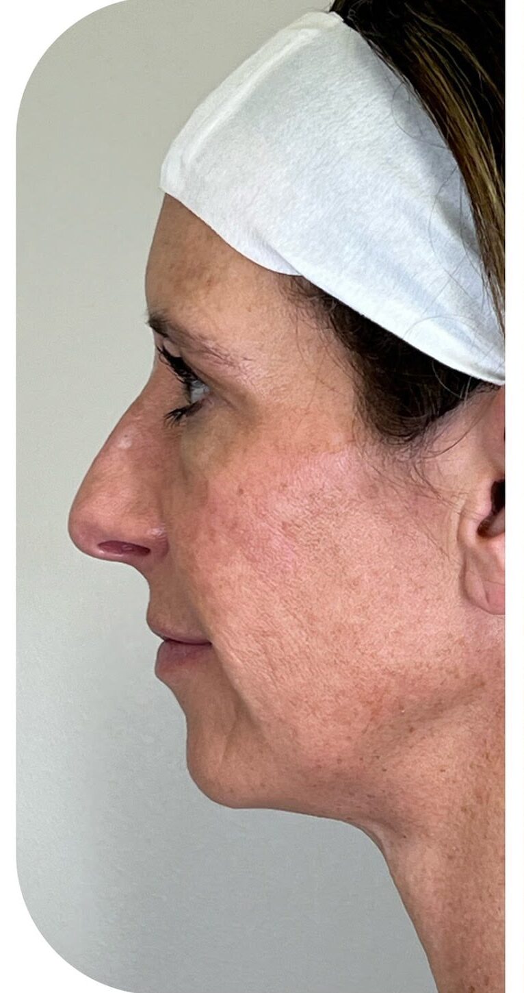 Before Image: Biostimulator - left-side