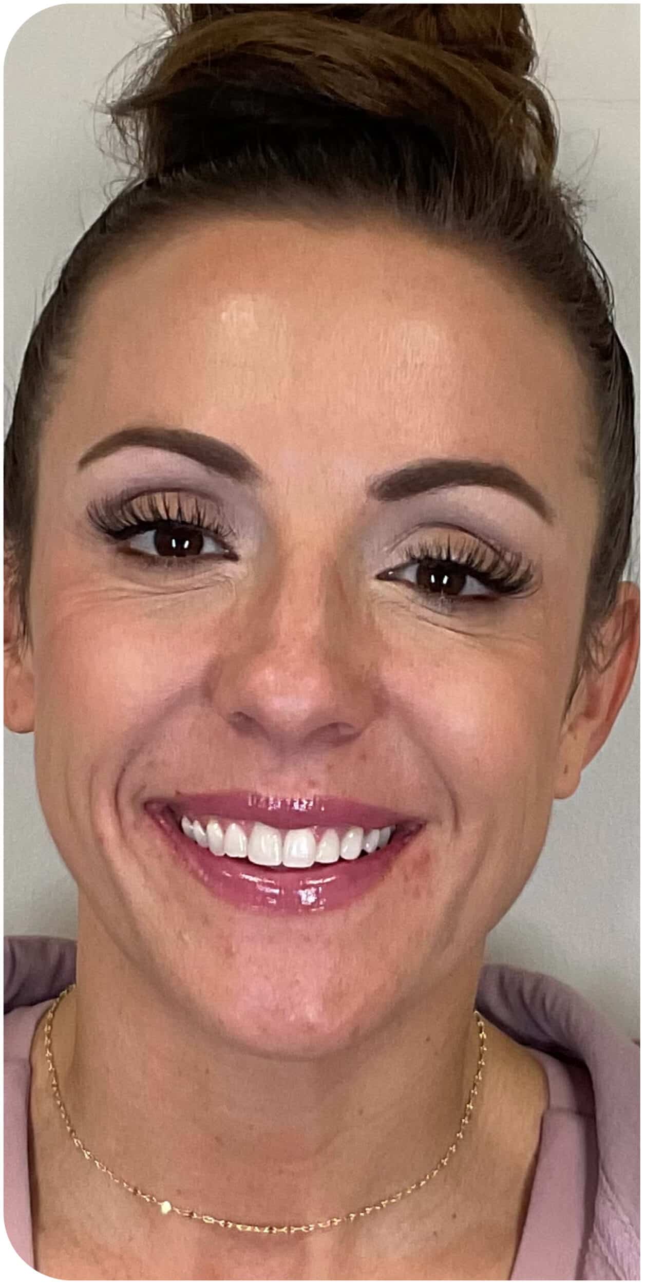 Before Image: CO2 Skin Resurfacing - front