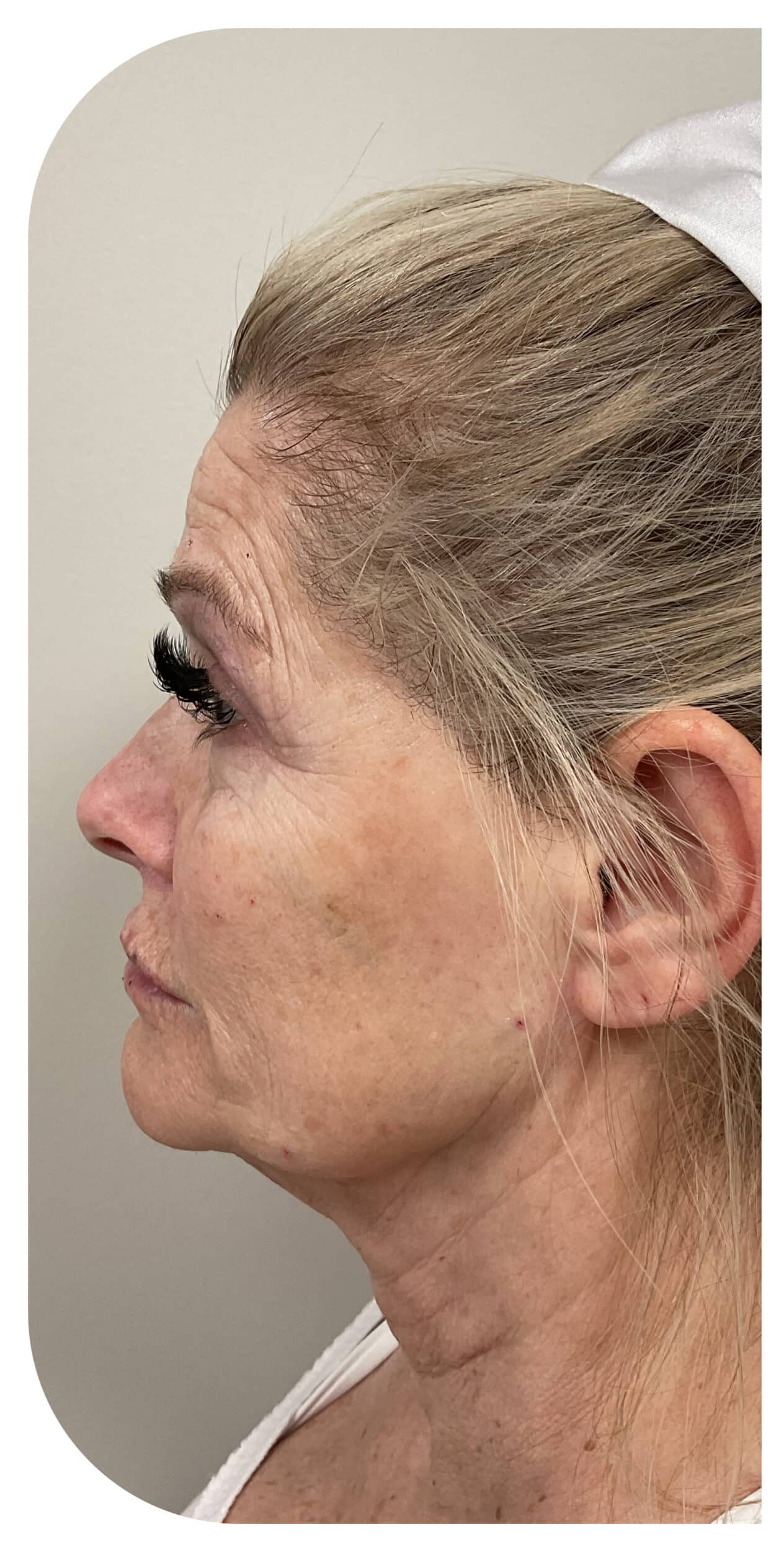 Before Image: Radiesse biostimulator and PDO threads - left-side