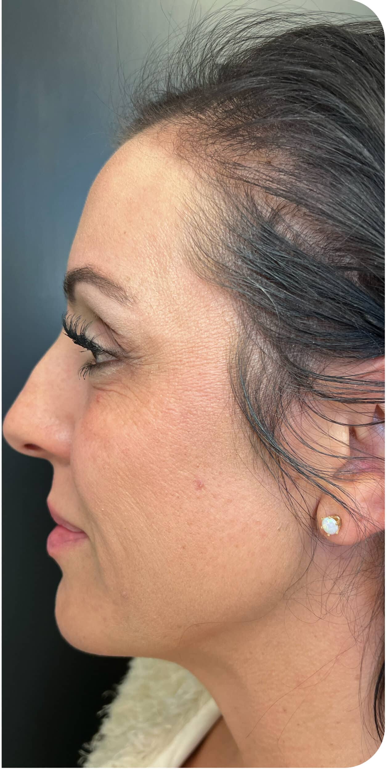 After Image: Biostimulator - left-side