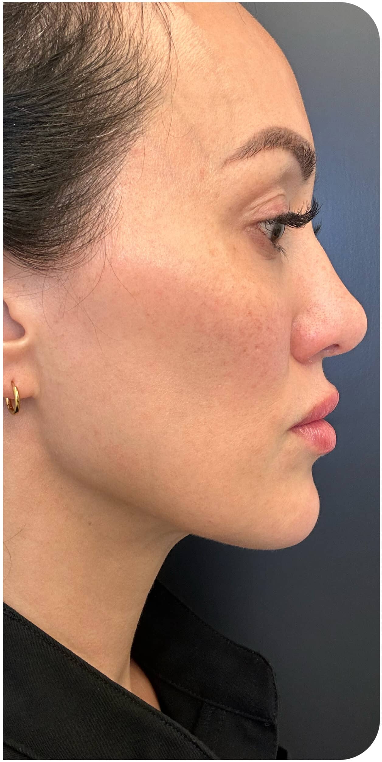 After Image: Biostimulator and CO2 Skin Resurfacing - right-side