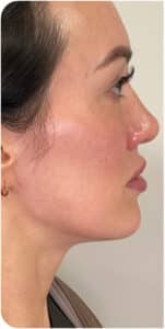 Before Image: Biostimulator and CO2 Skin Resurfacing