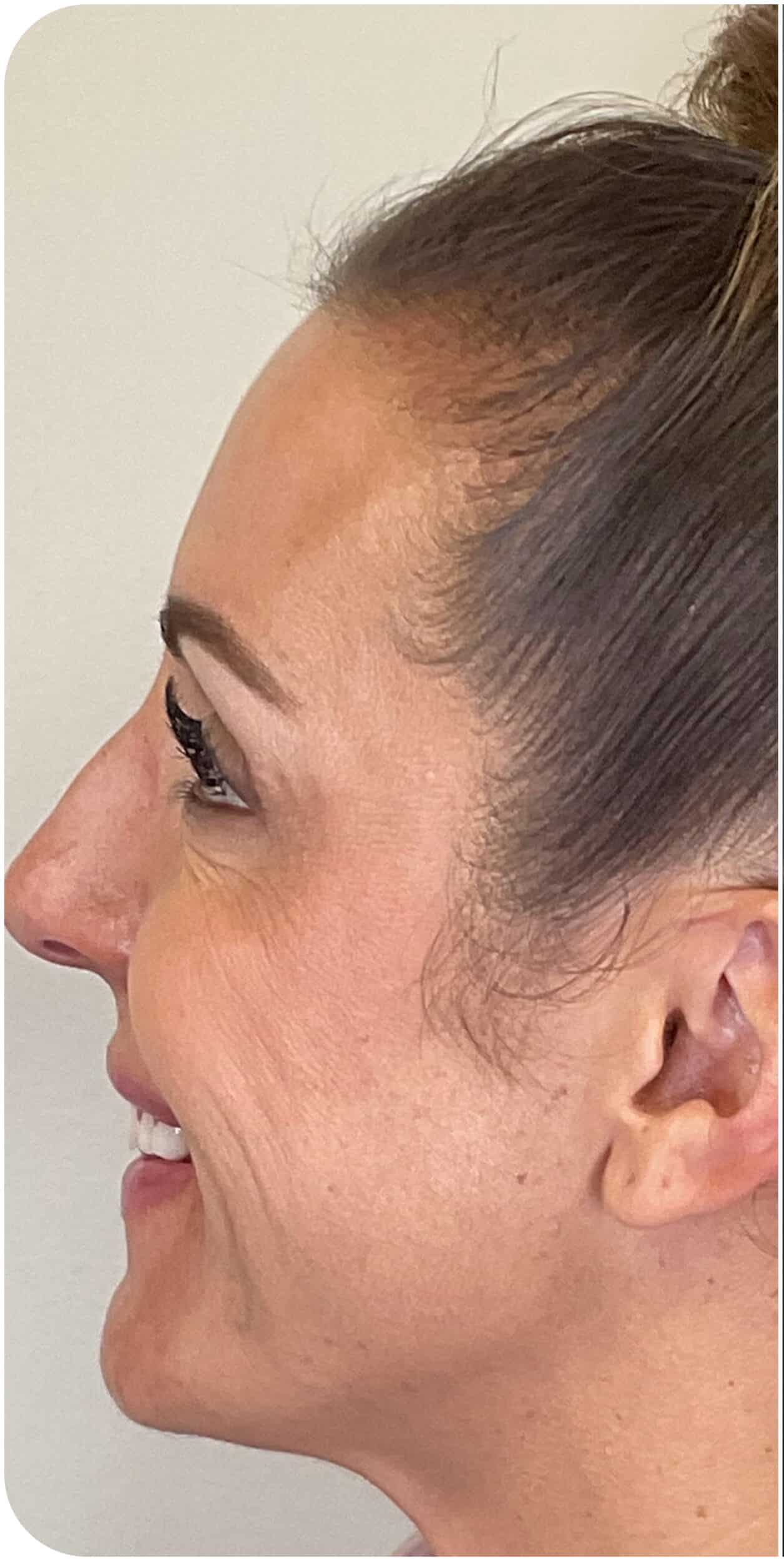 Before Image: Biostimulator - left-side