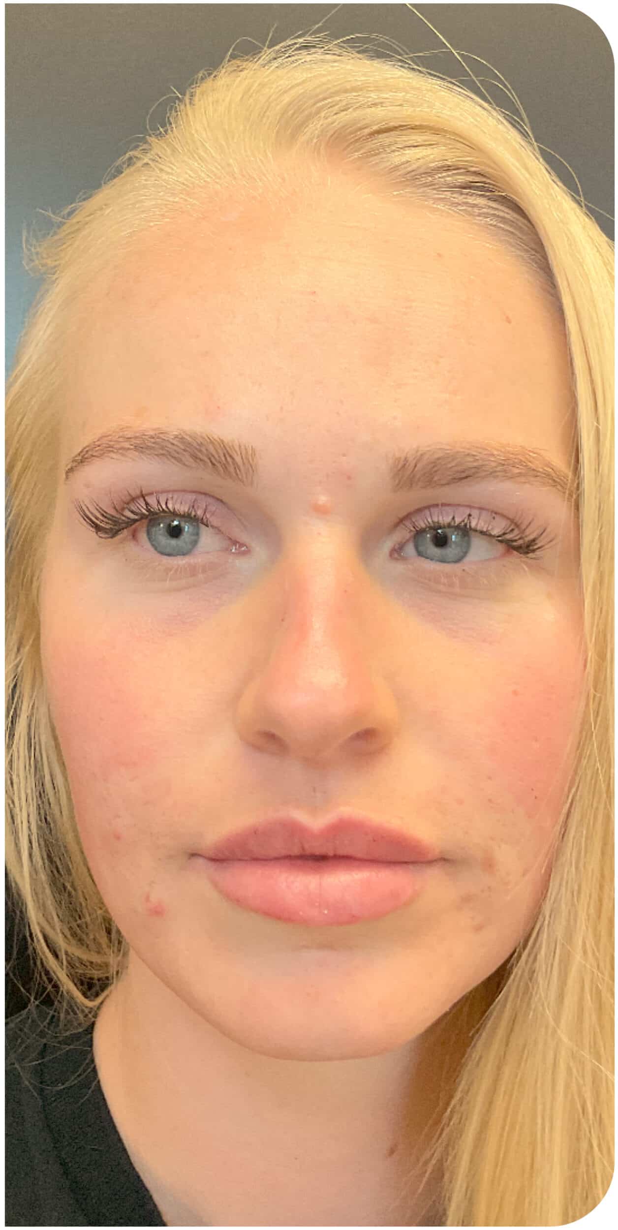 After Image: Lip Filler - front
