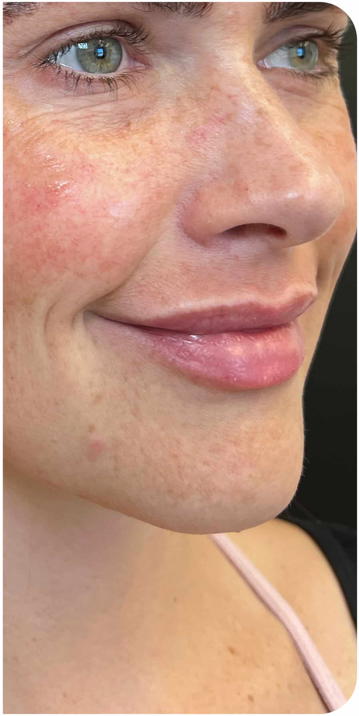 After Image: Lip Filler and Facial Framing - right-front-oblique