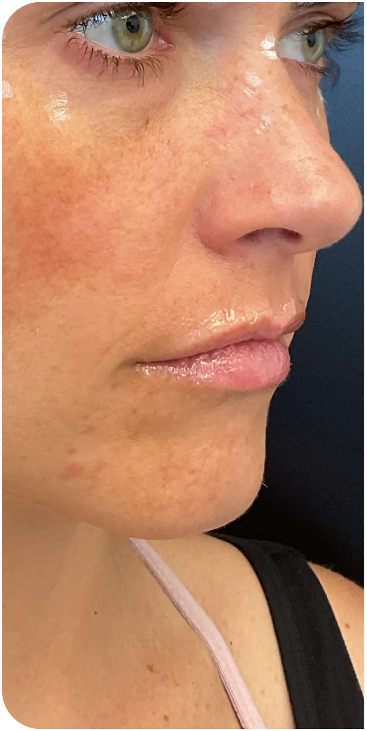 Before Image: Lip Filler and Facial Framing - right-front-oblique