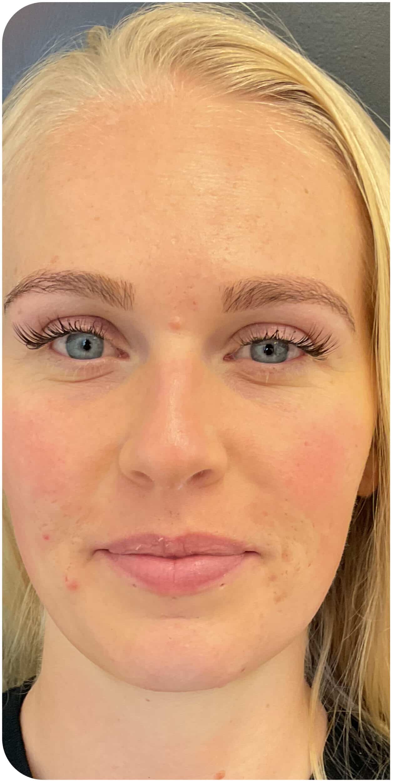 Before Image: Lip Filler - front