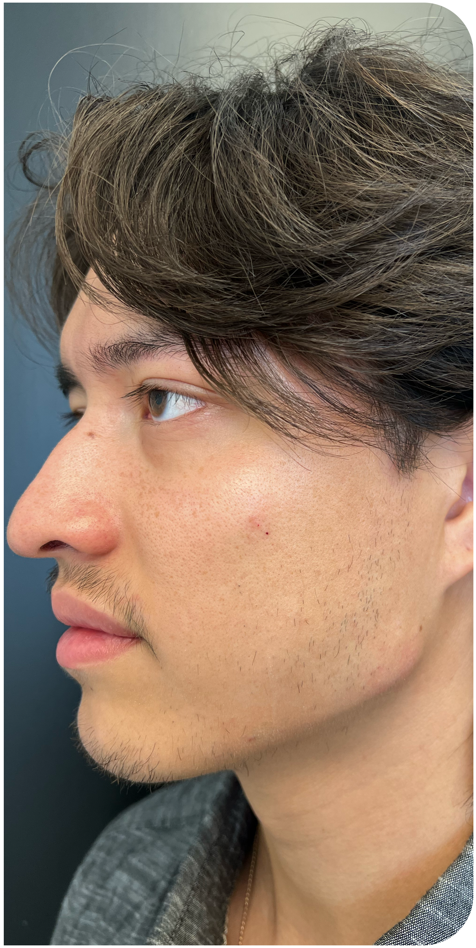 After Image: Jawline - left-side