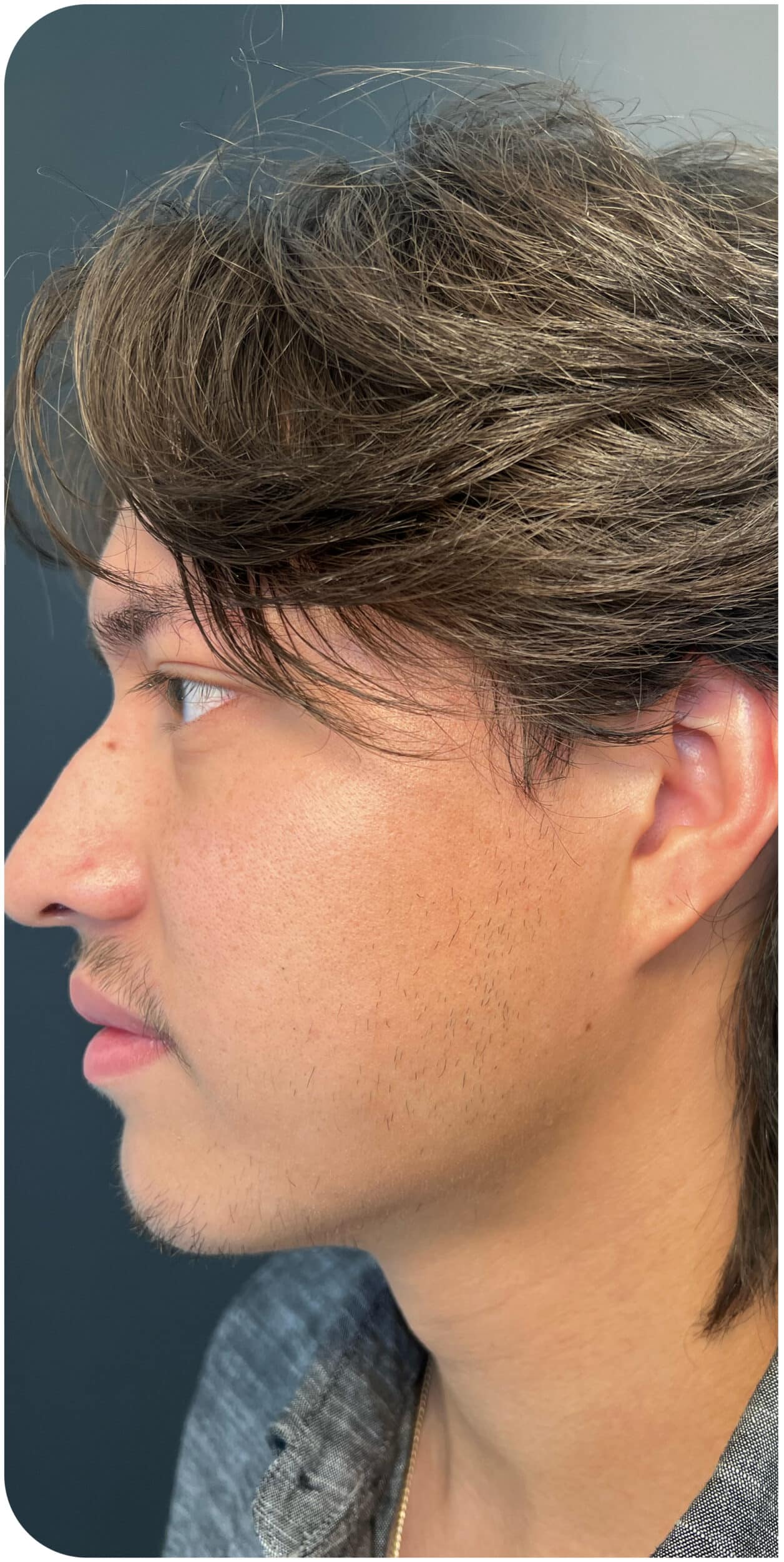 Before Image: Jawline - left-side