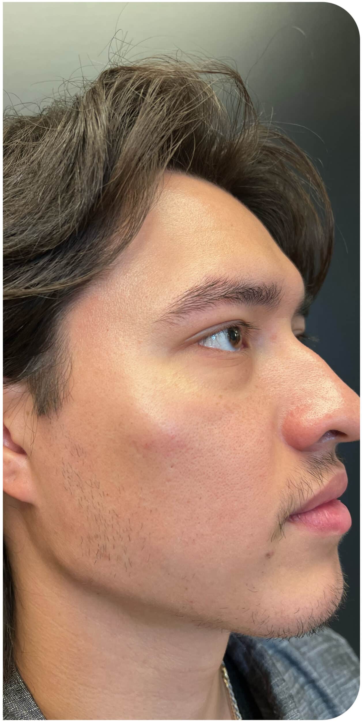 After Image: Jawline - right-front-oblique