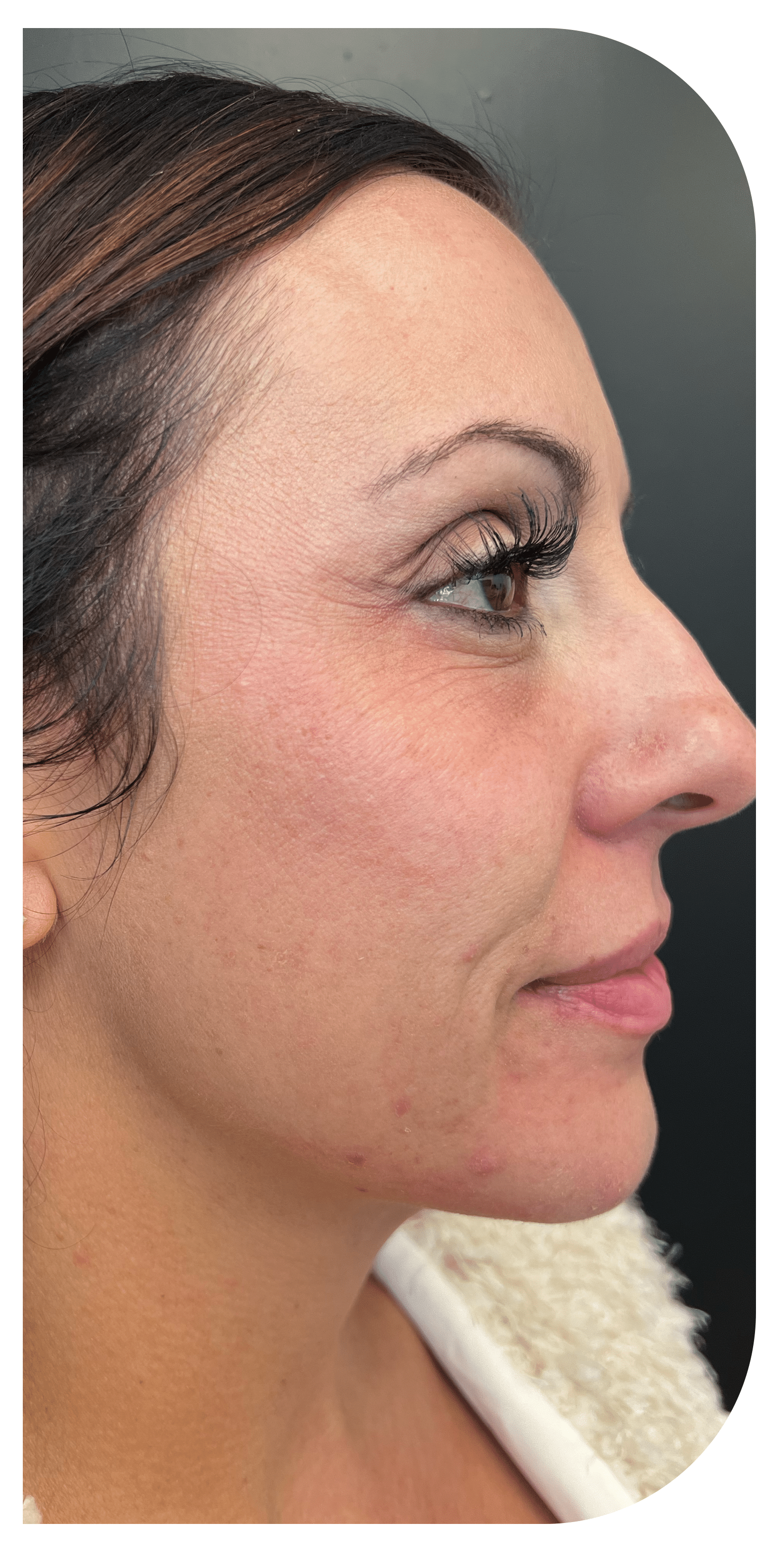 After Image: CO2 Skin Resurfacing - right-side