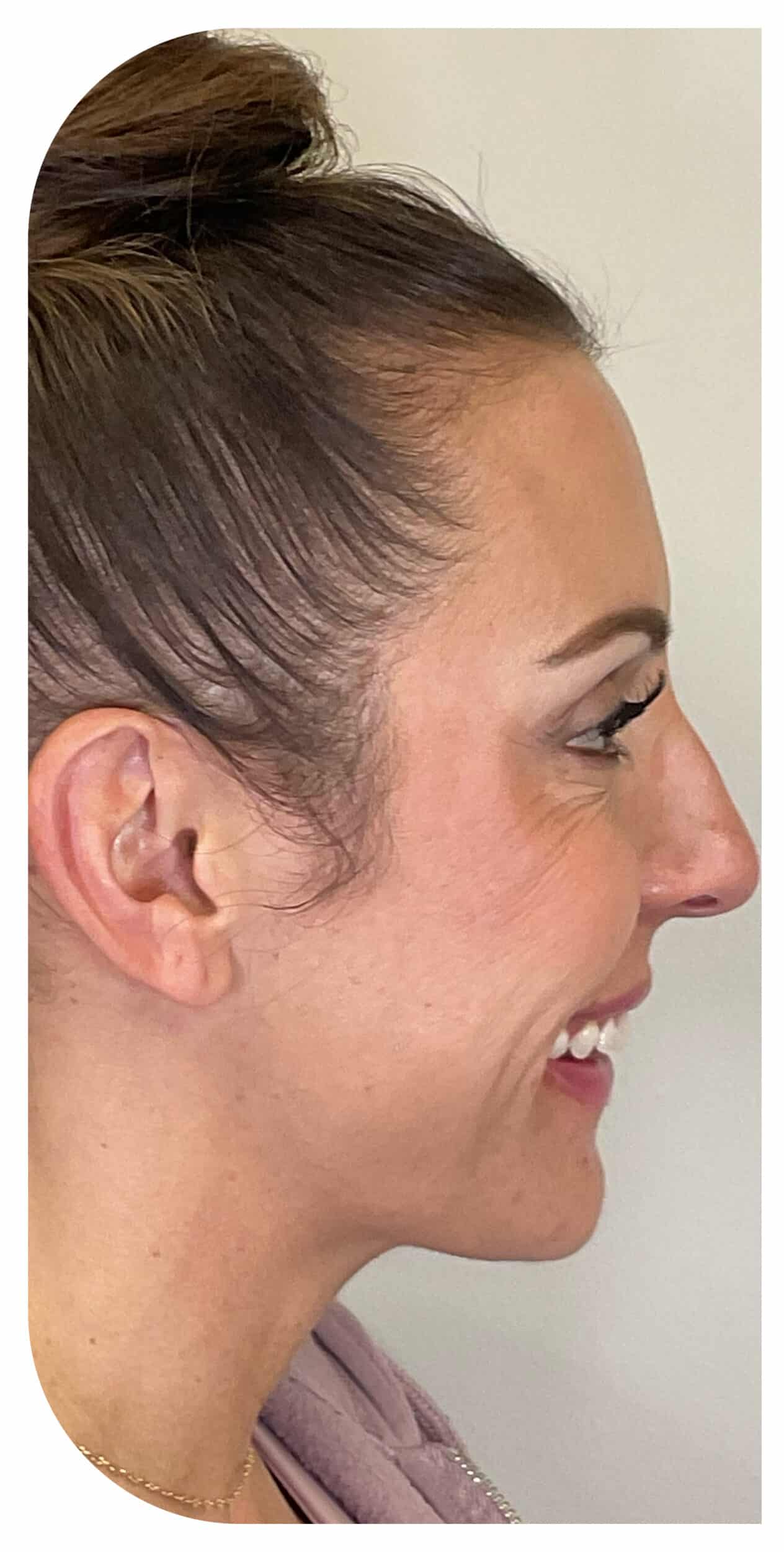 Before Image: CO2 Skin Resurfacing - right-side