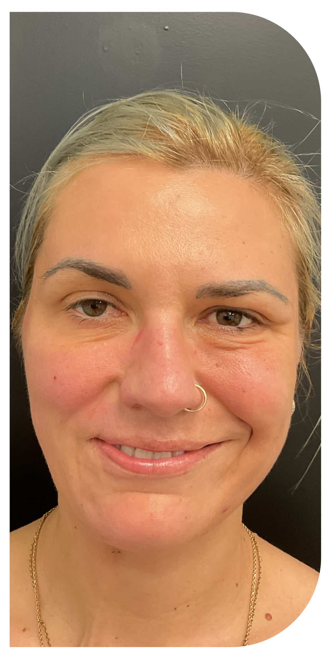 After Image: Botox on facial paralysis - front