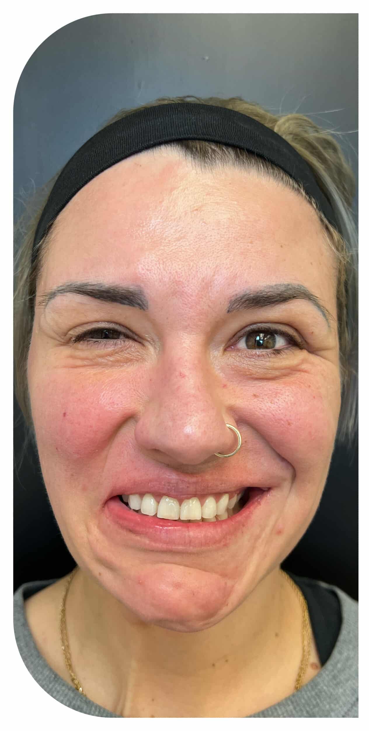 Before Image: Botox on facial paralysis - front