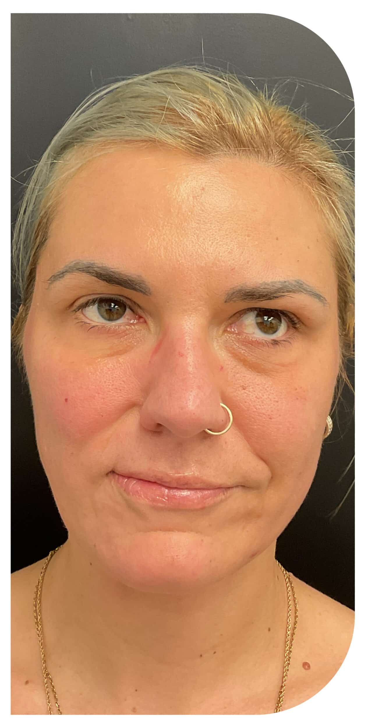 After Image: Botox on facial paralysis - front