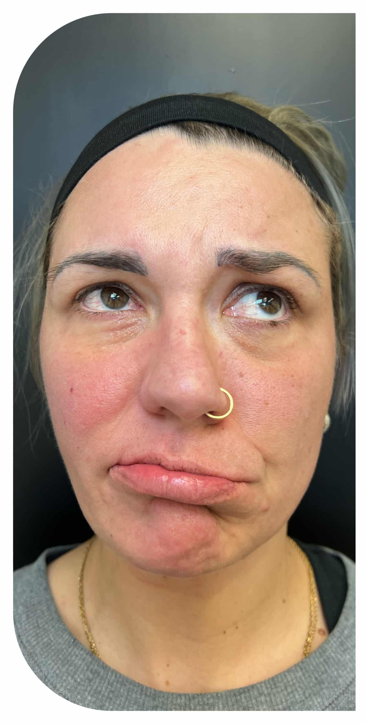 Before Image: Botox on facial paralysis - front