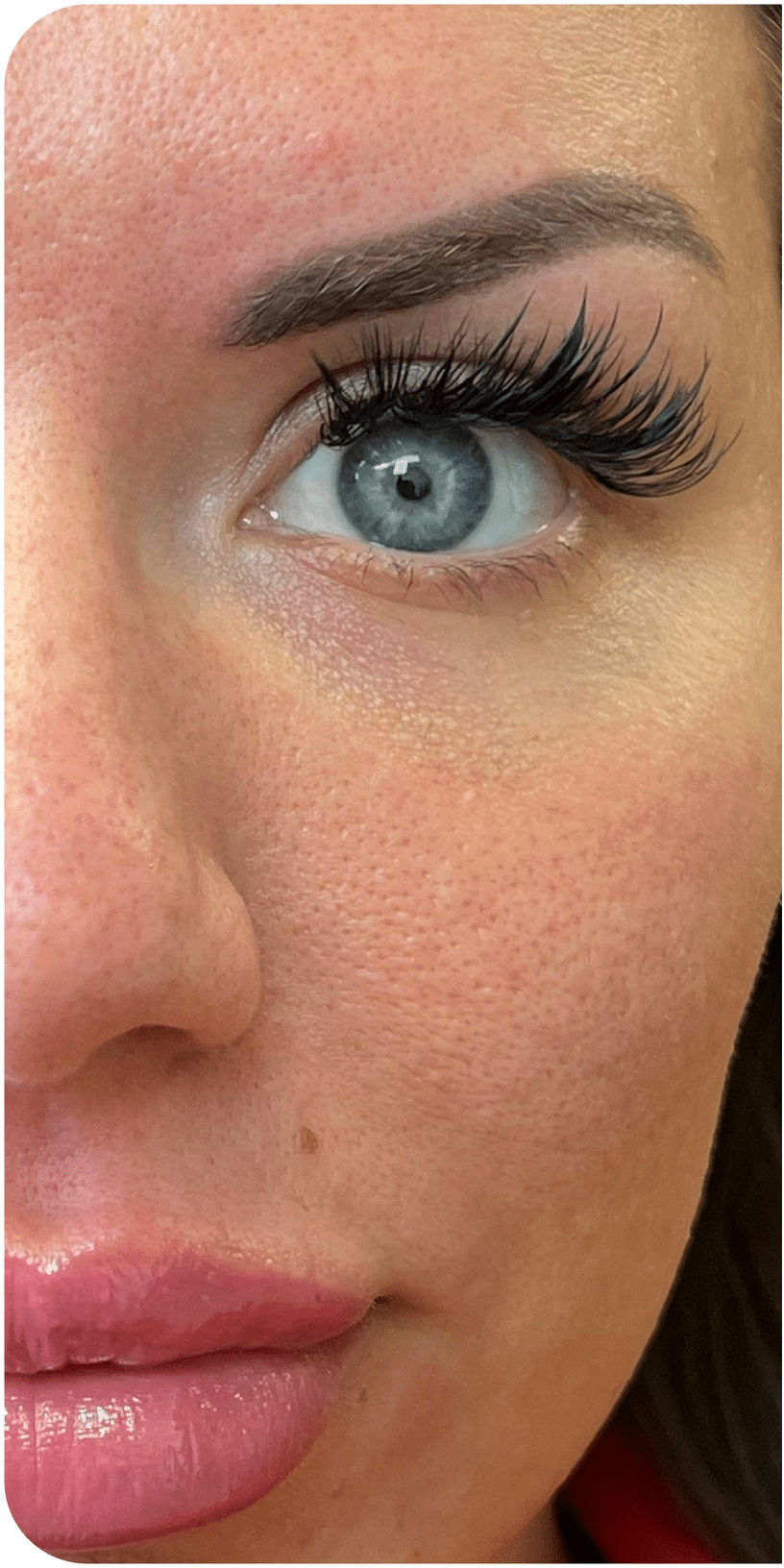 Before Image: CO2 Skin Resurfacing - front