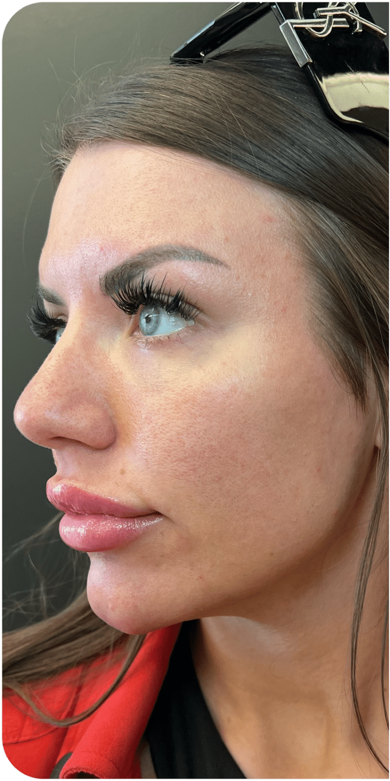 Before Image: CO2 Skin Resurfacing - left-side