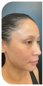 Before Image: Facial Balancing Lip framing