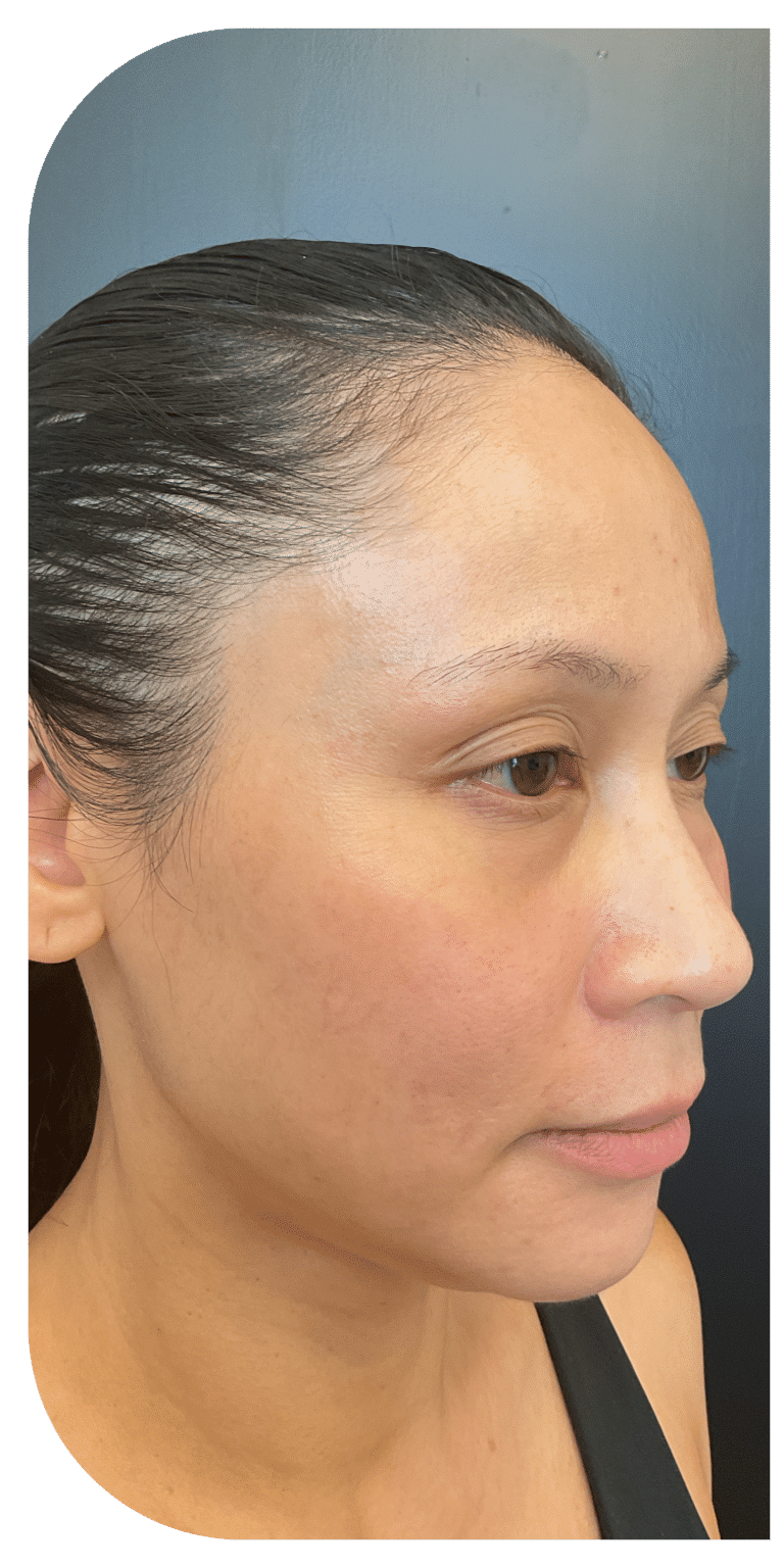 Before Image: Facial Balancing Lip framing - right-side