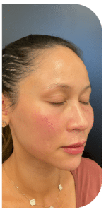 After Image: Facial Balancing Lip framing