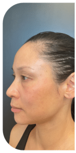 Before Image: Facial Balancing Lip framing