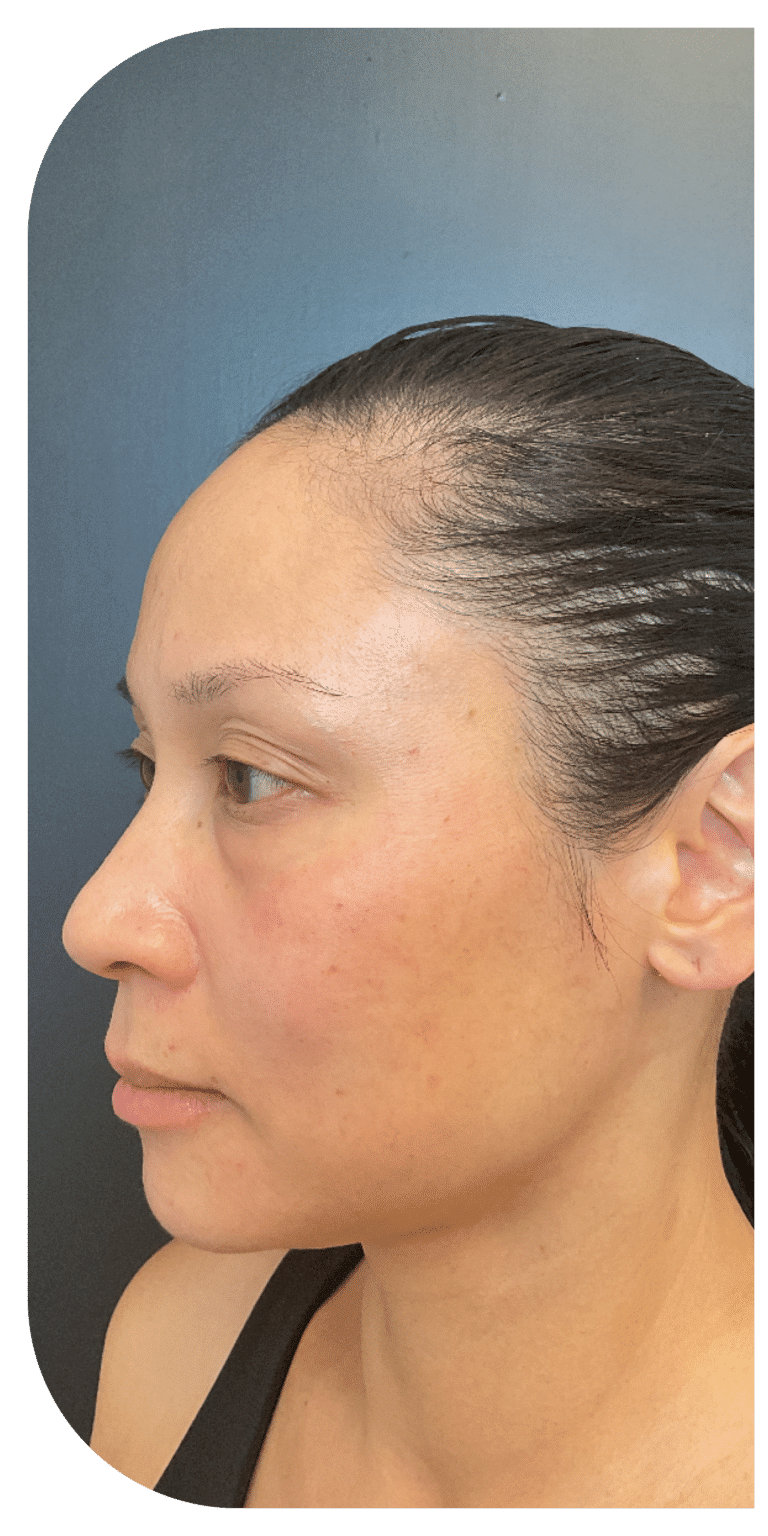 Before Image: Facial Balancing Lip framing - left-side