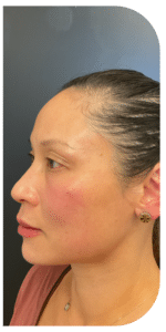 After Image: Facial Balancing Lip framing