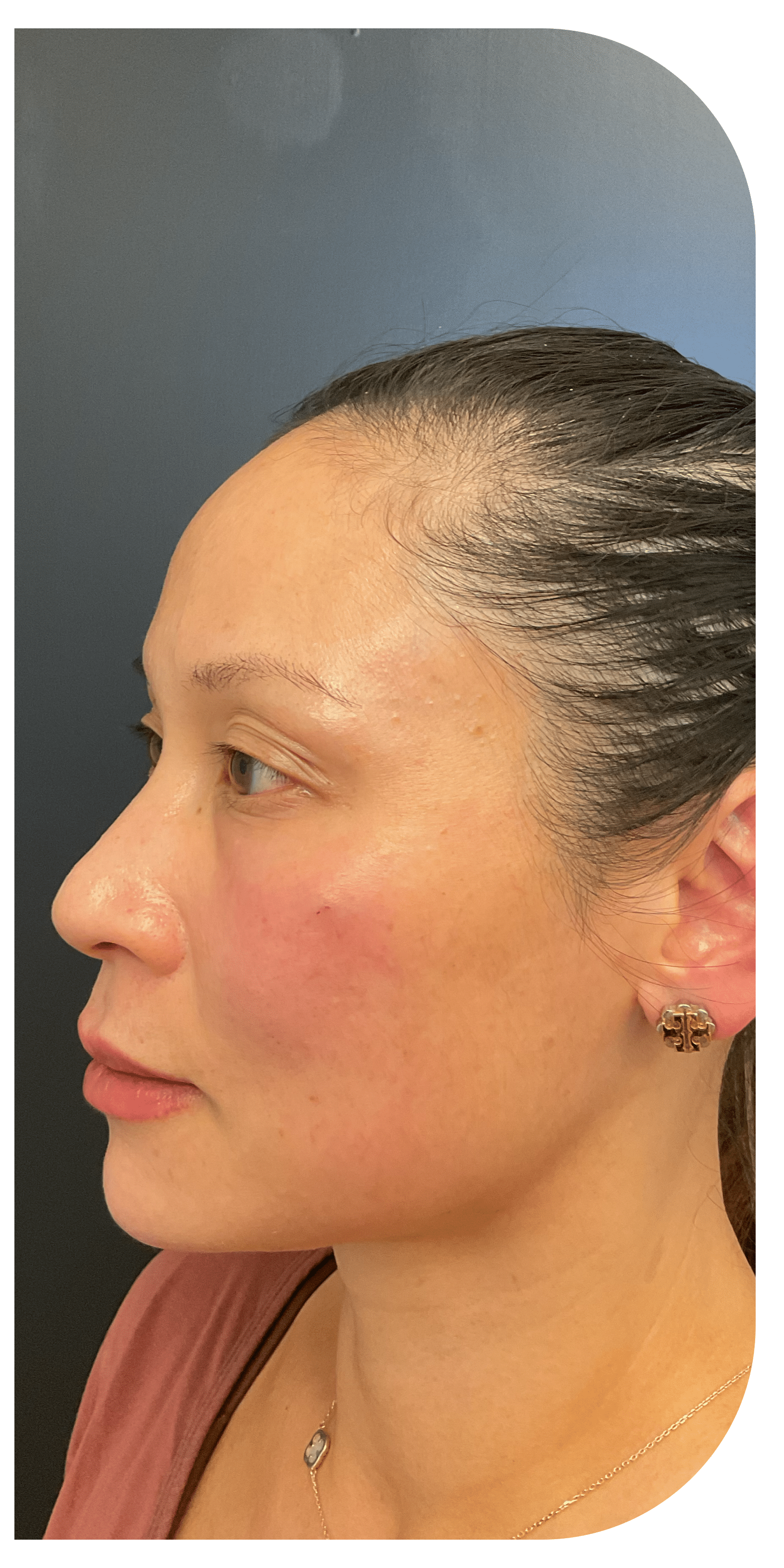 After Image: Facial Balancing Lip framing - left-side