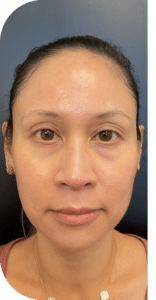 Before Image: Facial Balancing Lip framing