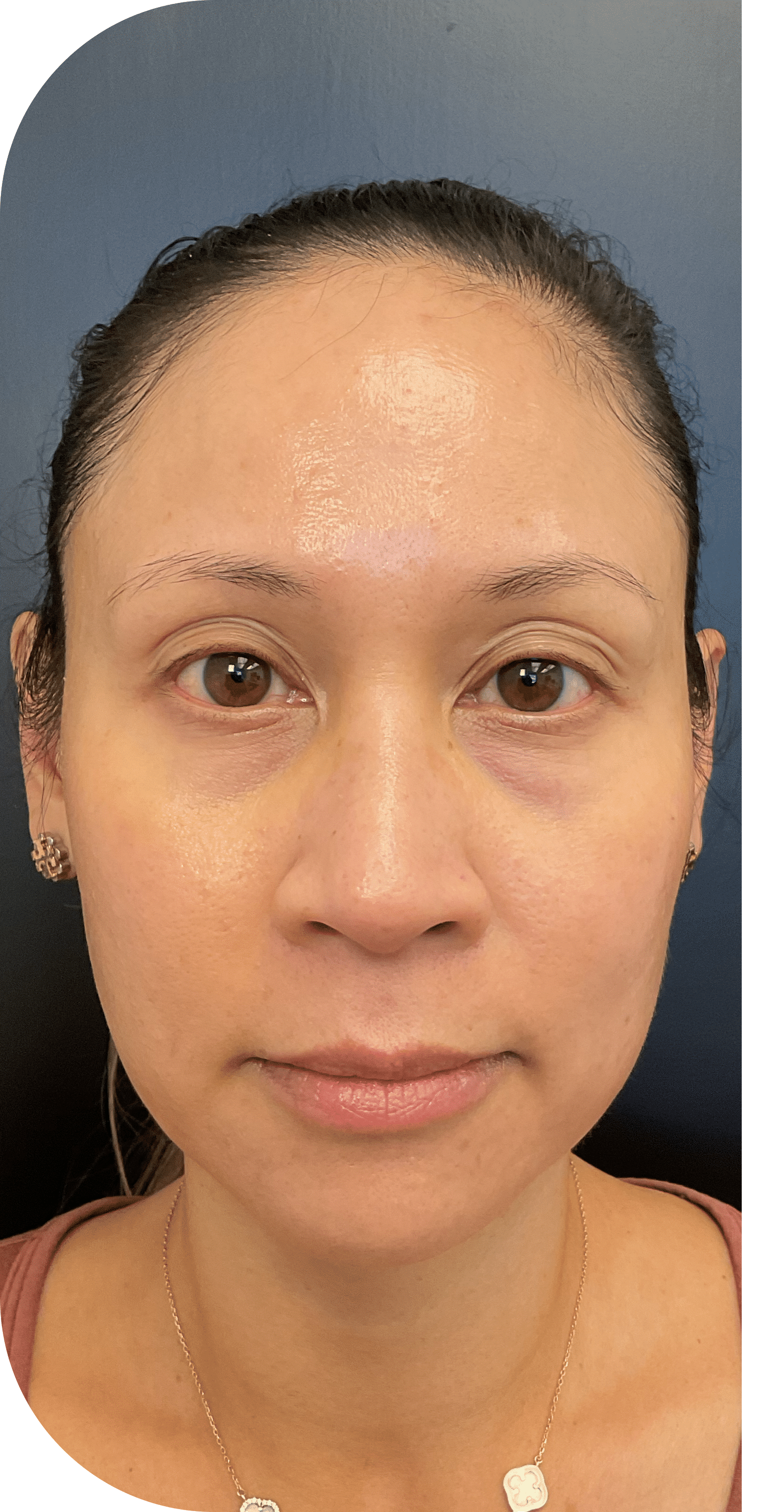 Before Image: Facial Balancing Lip framing - front