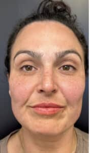 After Image: Lip Filler and Facial Framing