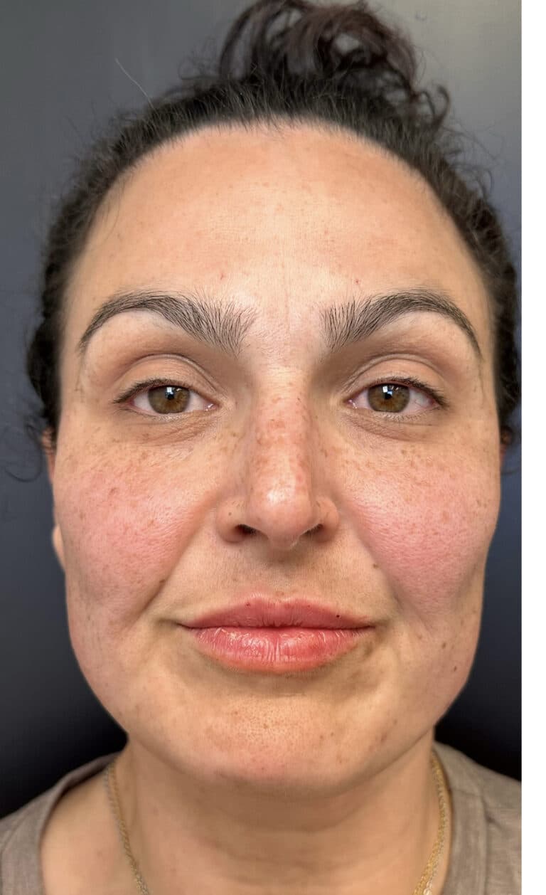 After Image: Lip Filler and Facial Framing - front