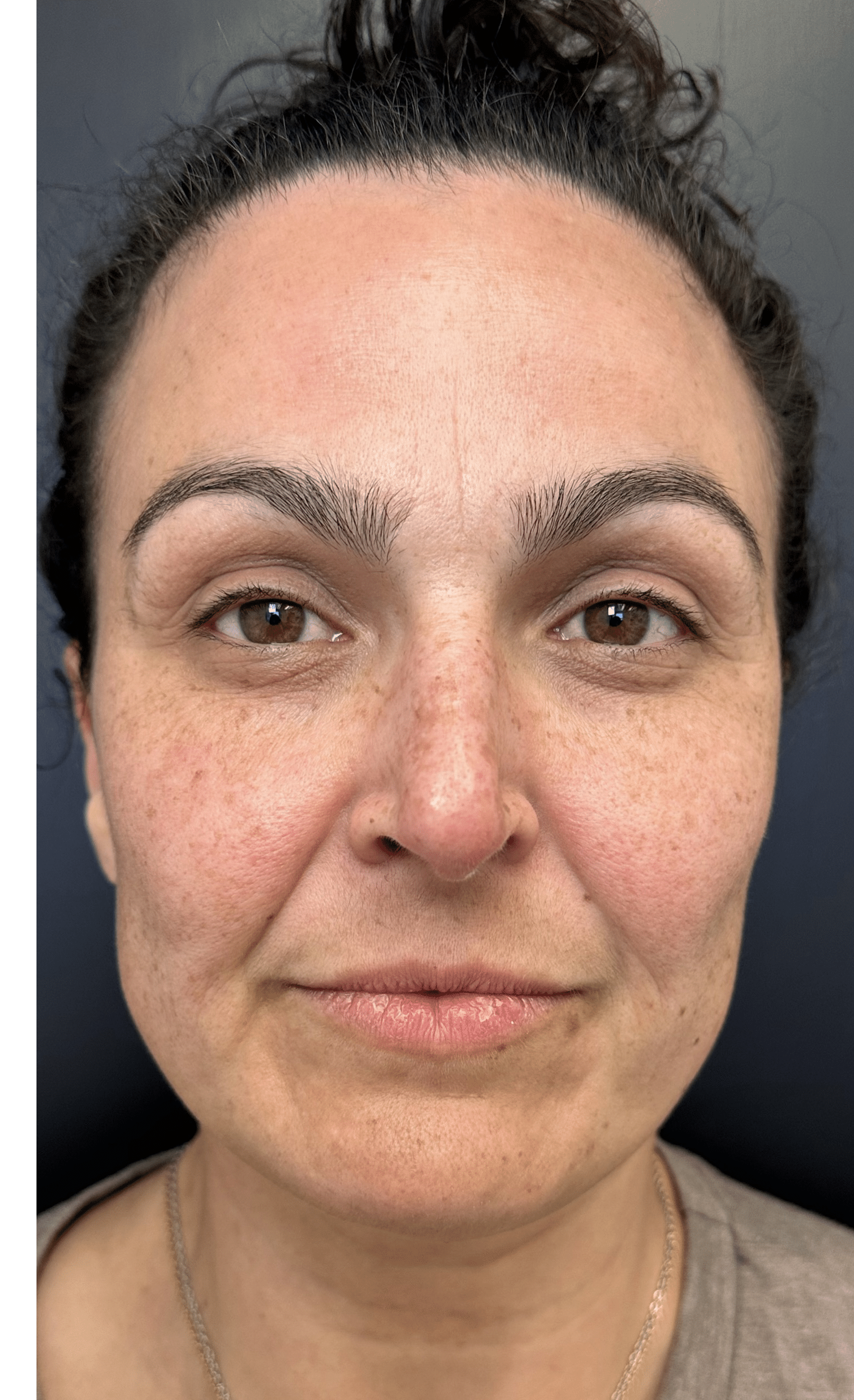 Before Image: Lip Filler and Facial Framing - front