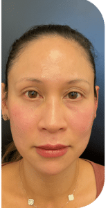 After Image: Facial Balancing Lip framing